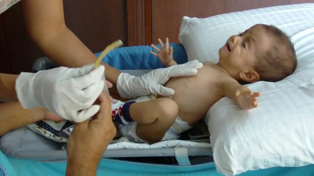 Extracción de sonda de gastrostomía