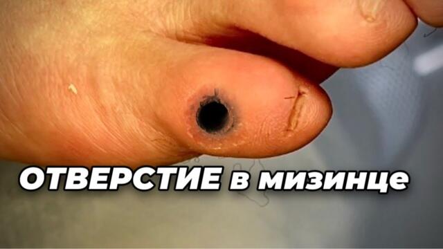 Полость после удаление кожного уплотнения на мизинце.