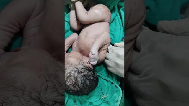 Breech Baby with Abnormalities #viral #cutebaby #baby #cute