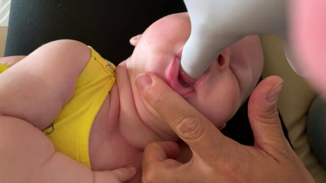 Proper tongue function of an Infant for effective feeding