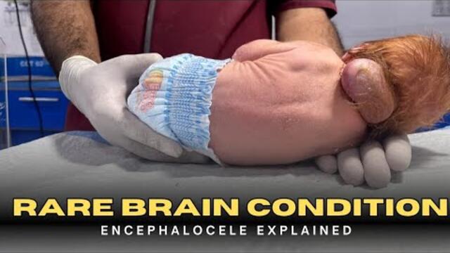 Baby Encephalocele Explained | Causes, Symptoms & Treatment