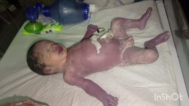 🩺🍼💗🩺"Critical Newborn Care: Managing Gasping Condition in Neonates - Expert Insights"