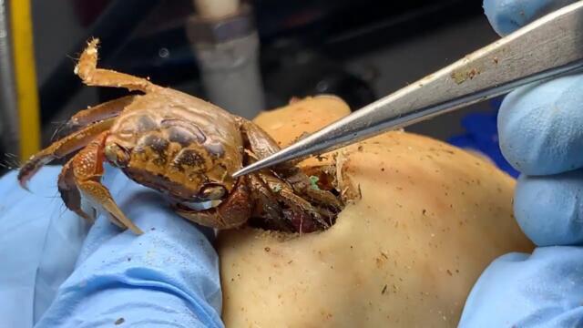 New S1 TLC DR LEE’S ULTIMATE ZITPOPPER  with Tweezer とんでもなく嬉しいことが起きたので報告します X1606 2166