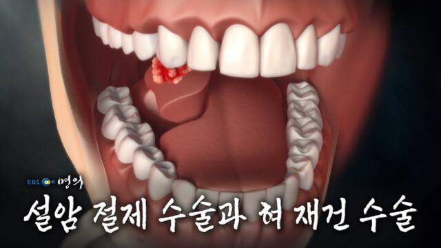 [명의 의학백과📖] 설암 절제 수술과 혀 재건 수술