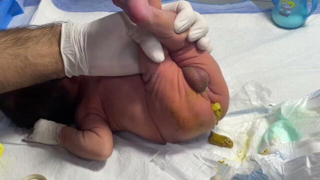 Newborn Baby in NICU | Suppository Procedure for Abdominal Distension 💊👶#baby #nicu #cute #newborn