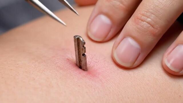 Satisfying Random Object Removal V2｜피부에 깊숙히 박힌 물체 제거 2편