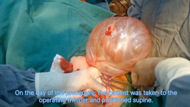 Ovarian cyst removal | Medical Training Steps |