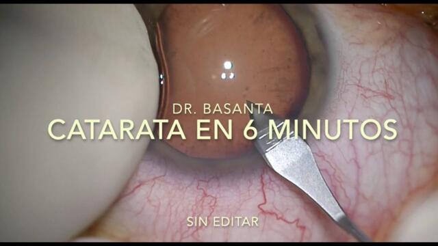 CATARATA EN 6 MINUTOS (sin cortes)