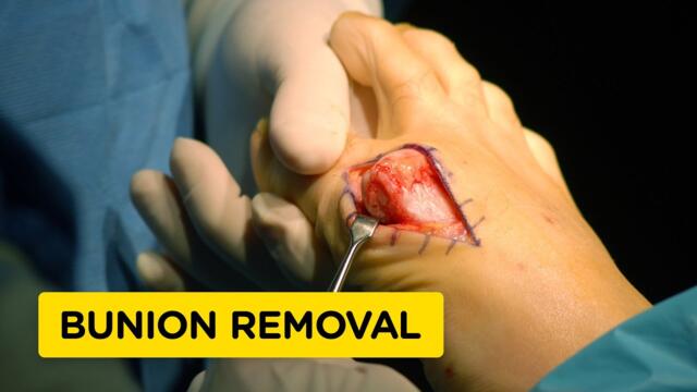 How Bunions Are Removed (Bunionectomy Surgery Animation)