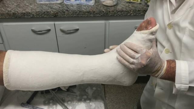 Artigo Ortopédico Moldável Polar Fix Tala tipo Bota