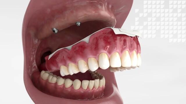 Smart Denture Conversions Animation