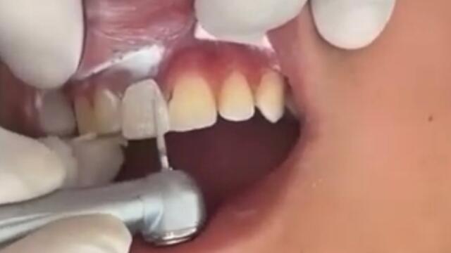 Central superior en resina Video N 53 #lacintapd #adn #geometriasagrada  #geometriasagrada #🦷