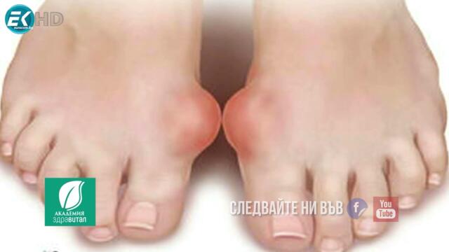 Всичко за подаграта и синдрома на Райтер - „Академия Здравитал“ с водещ Проф. Христо Деянов