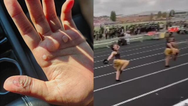 Teens Get Painful Blisters After Punishment By Dance Coach: Parents