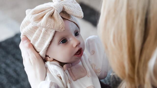 Baby Born with Rare Syndrome That Doesn’t Allow Her To Close Her Eyes