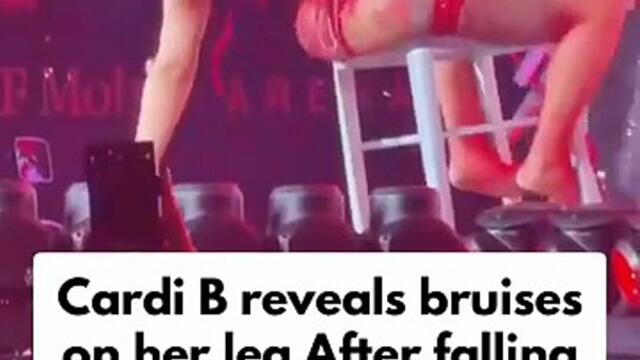 Hollywood singer Cardi B reveals bruises on her leg following a fall during her music concert