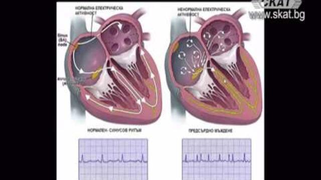 Академия ЗдравОсловно: Възбудно-проводна система на сърцето