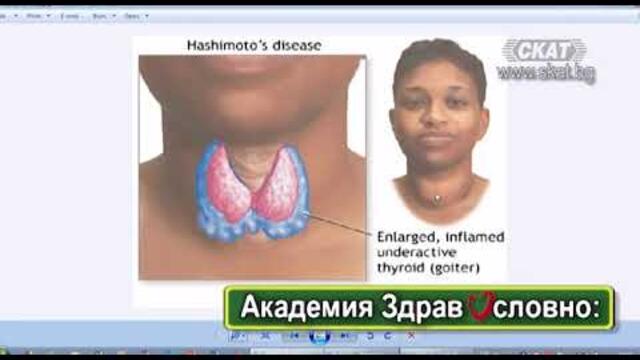 Академия Здравословно: Болестта на Хашимото - причини, симптоми и поведение