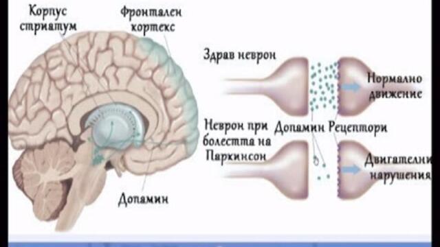 Академия ЗдравОсловно: Болестта на Паркинсон