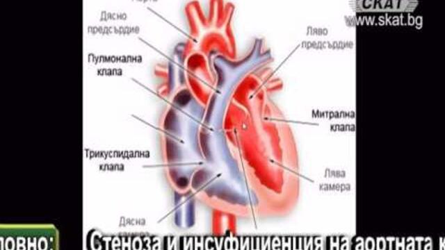 Академия ЗдравОсловно: Стеноза и инсуфициенция на аортната клапа