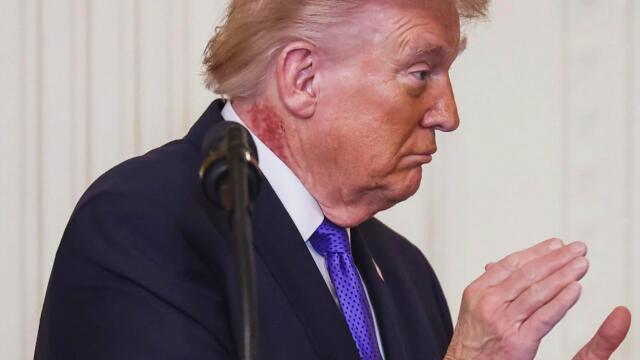 What Is On President Donald Trump's Neck?