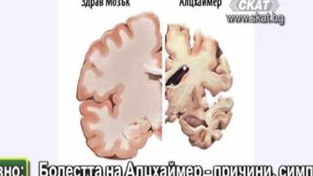 Болестта на Алцхаймер - причини, симптоми, диагностика, профилактика и лечение