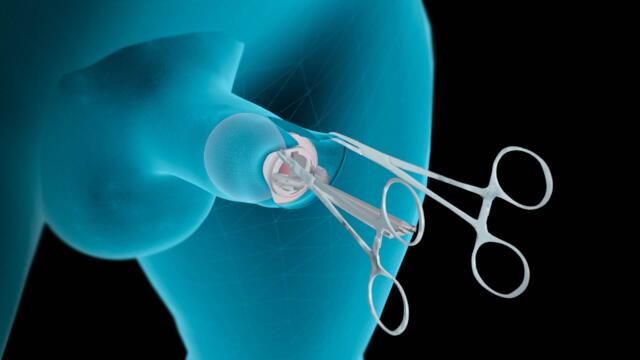 Así es el proceso de circuncisión