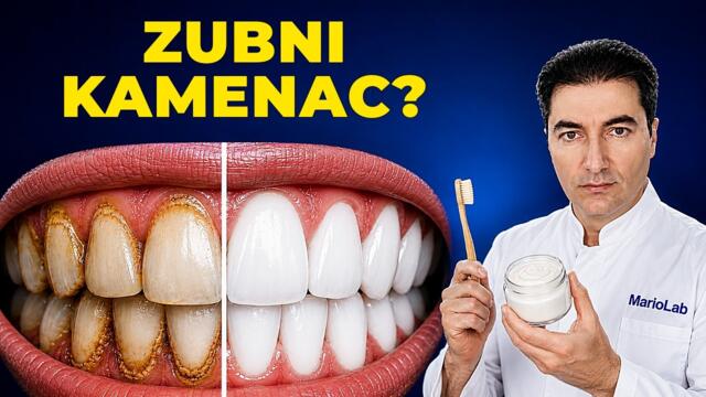 Kako prirodno ukloniti zubni plak i kamenac kod kuće?