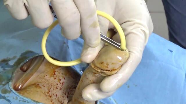 Pemasangan Kateter - Dr  dr Jufriady Ismy, Sp U