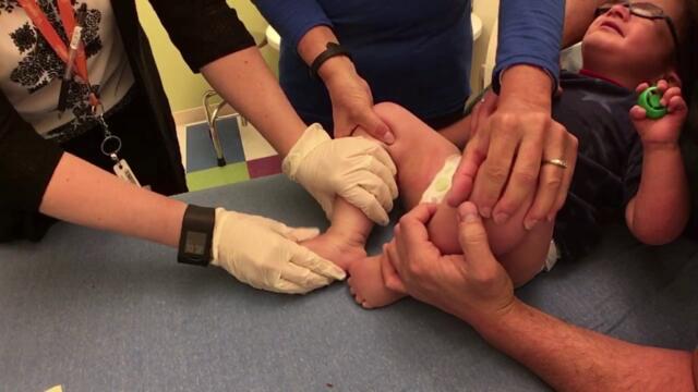 Botox injections in child’s legs