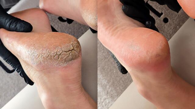 The Deepest Cracked Heels I've Ever Fixed