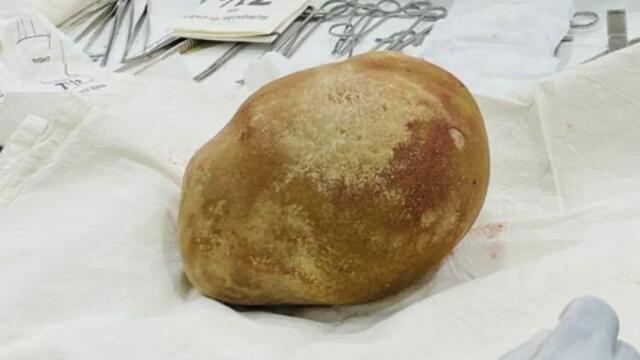 Doctors Remove Nearly 7-Pound Bladder Stone From Patient