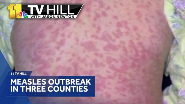 11 TV Hill: Measles tips shared for families as school starts
