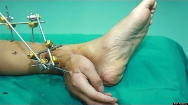 Хирурзи в Китай направиха екстремна процедура