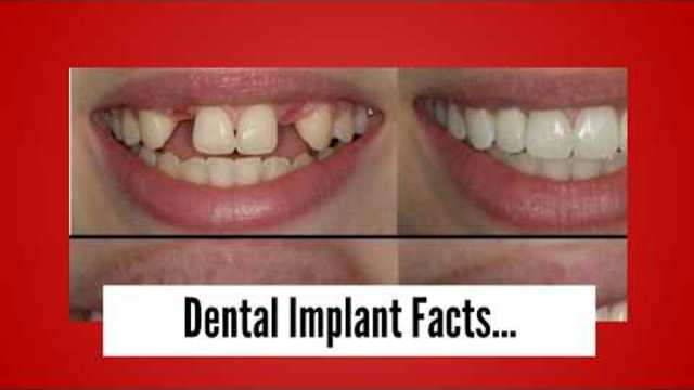 Dental implant facts