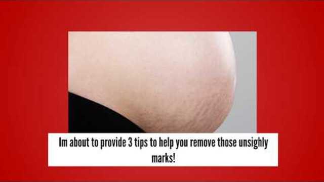 Stretch Mark Removal