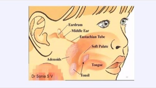 Академия "Здравословно": Вазомоторна хрема(вазомоторен ринит)