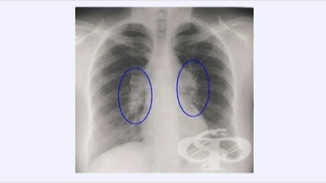 Саркоидоза - диагностика, профилактика и лечение