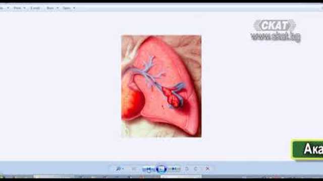 Белодробна емболия - причини, клиника, профилактика и лечение