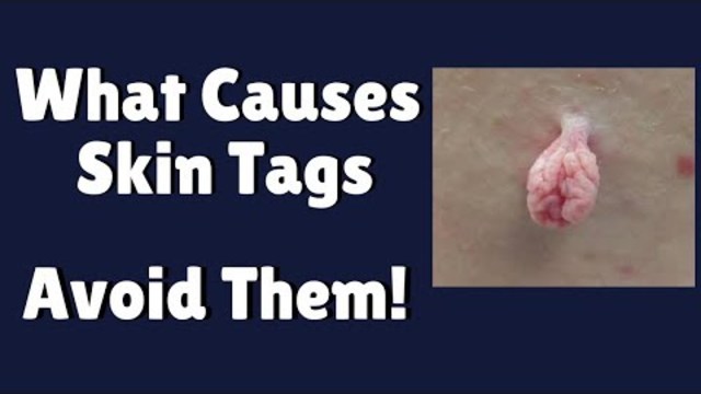 What Causes Skin Tags | Know The Reason For Skin Tags So You Can Avoid Them
