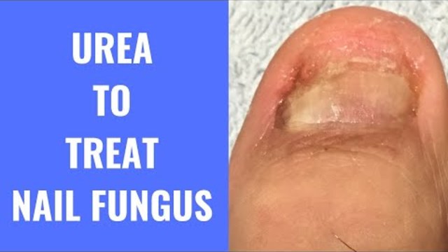 Use Urea To Treat Nail Fungus