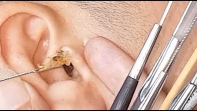 Cara membersihkan kotoran telinga  (video 36)