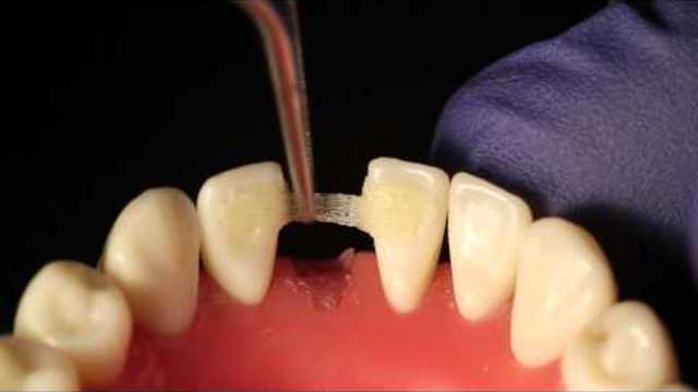 Вижте как се конструира зъб директно на мястото на липсващият ви! Ribbond Single Visit Bridge Technique